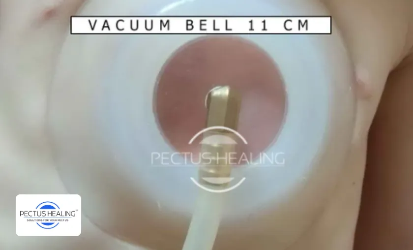 How Pectus Healing Products Work!