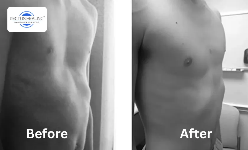 The Story of Pectus Healing!